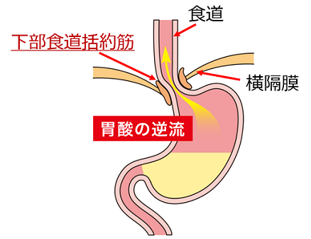 胃酸の逆流